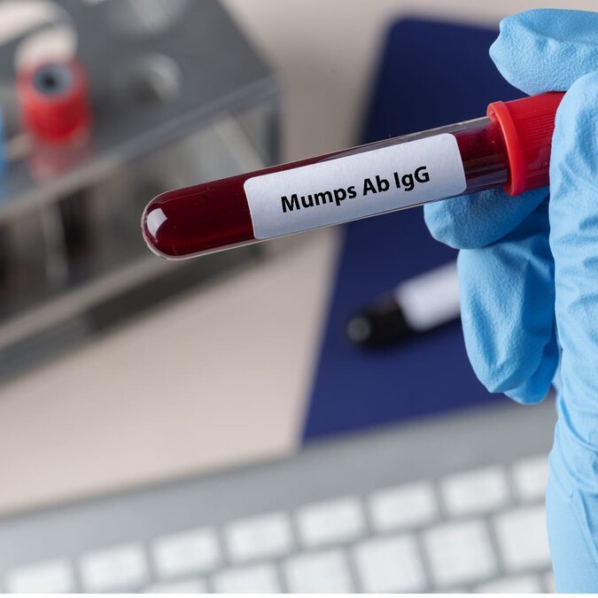 Mumps Ab IgG ( Kabakulak )